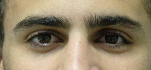 Пример глазных протезов